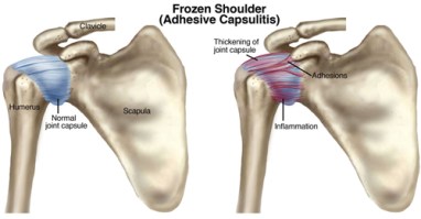 FrozenShoulder vs normal shoulder